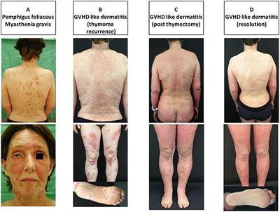 Thymoma-Associated Paraneoplastic Autoimmune Multiorgan Syndrome—From Pemphigus to Lichenoid Dermatitis